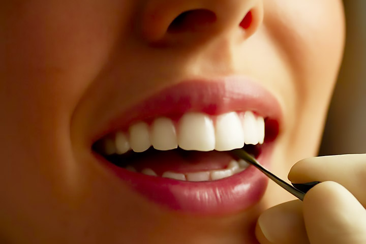 Подготовка зубов к установке брекетов